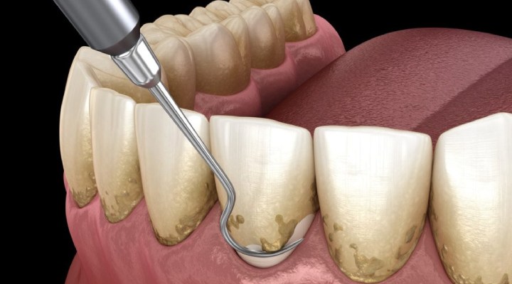 پریودنتیت؛ علت، علائم و روش درمان این بیماری جدی لثه 6 درمان پریودنتیت
