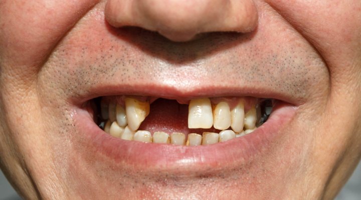 فردی بدون یک دندان جلو - پریودنتیت درمان‌نشده منجر به ازدست‌دادن دندان می‌شود
