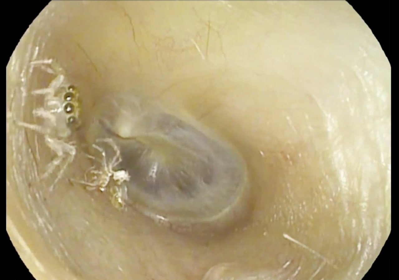 بیرون آوردن عنکبوت از یک گوش زن 64 ساله! + ویدیو