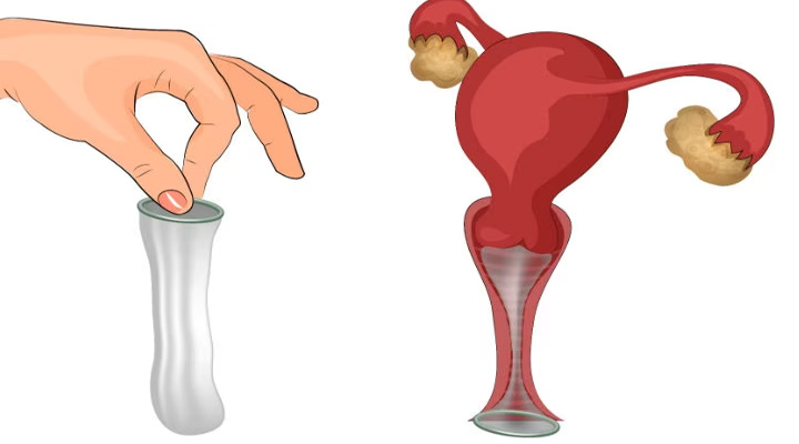 کاندوم زنانه؛ انواع، مزایا، معایب و روش استفاده_روشنفکر 7 نحوه استفاده از کاندوم زنانه